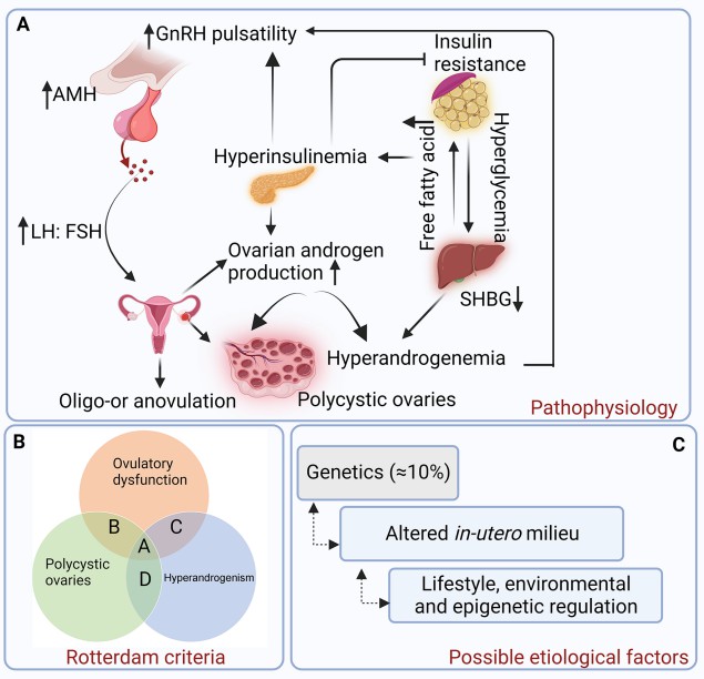 Diagram showing PCOS pathophysiology, Rotterdam diagnosis criteria, and potential causes.
