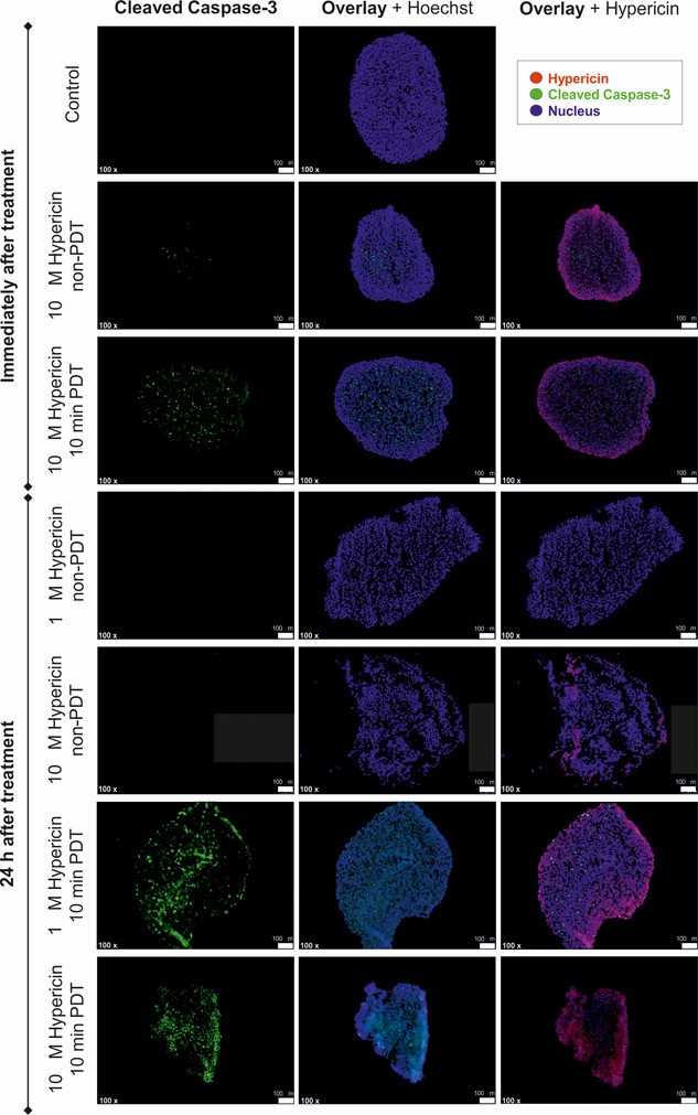 Effects of hypericin (HYP)-based photodynamic therapy (PDT) on cell proliferation and apoptosis