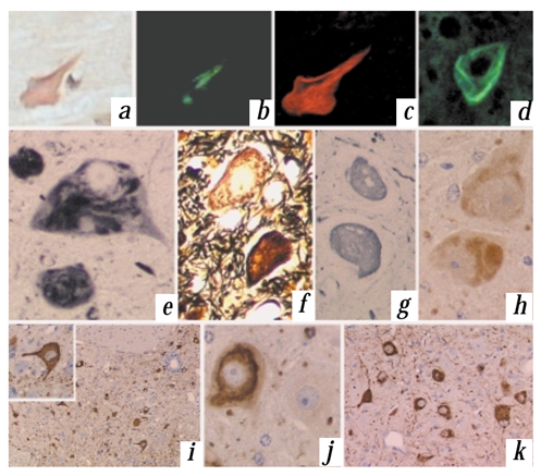 Characterization of NFT from P301L (JNPL3) mice. NFT stained with Congo red under light microscopy (a), with polarization (b), and under confocal microscopy (c). Thioflavin-S (d) also stained NFT. NFT were positive with Gallyas (e), Bielschowsky (f) and Bodian (g) silver stains. Ubiquitin immunostaining was identified in most NFT (h). Tau hyperphosphorylation was evident from staining with numerous tau antibodies that recognize specific phosphoepitopes including AT8 (i and inset), AT180 (j) and CP13 (k). All sections are from spinal cord except (k), which is from cerebellar dentate nucleus. 