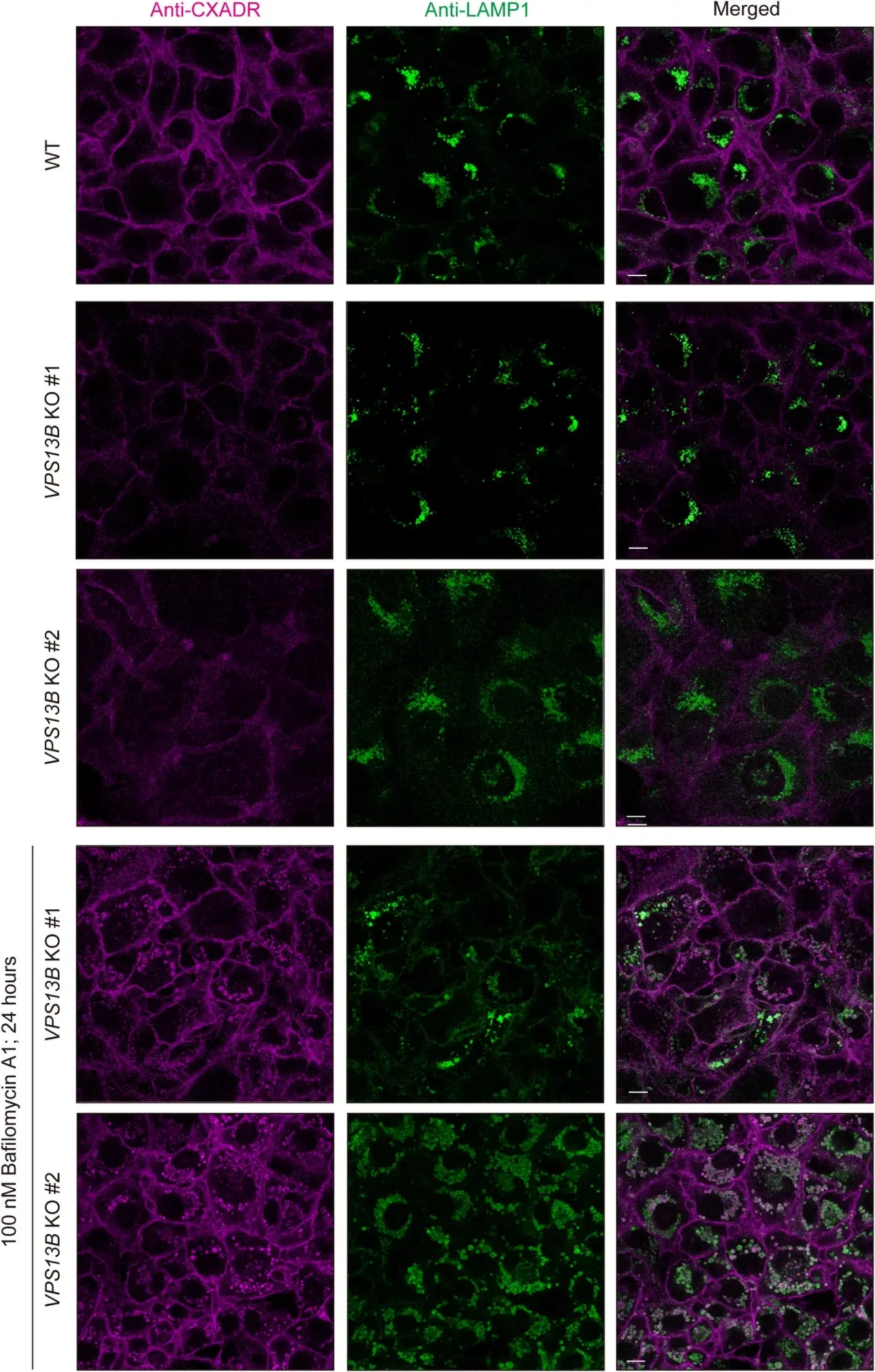 Loss of VPS13B causes abnormal transport of CXADR to lysosome in gingival epithelial cells.