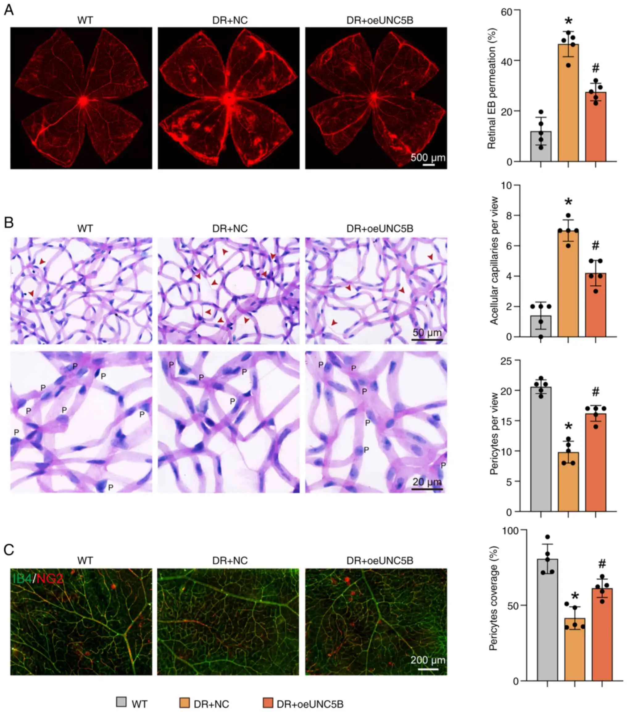 UNC5B overexpression in endothelial cells maintains blood-retinal barrier homeostasis in DR model mice.