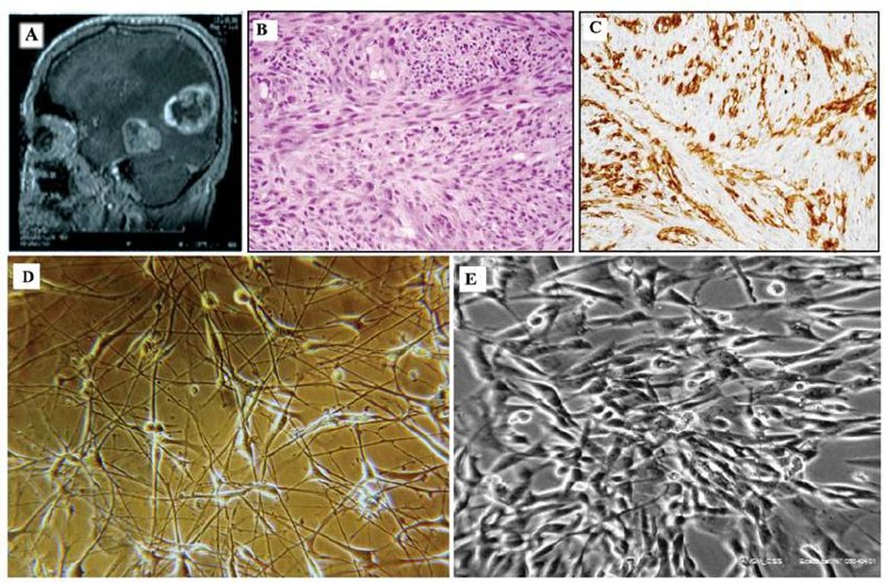 Morphological characteristics of the primary tumor and ANGM-CSS cell line.