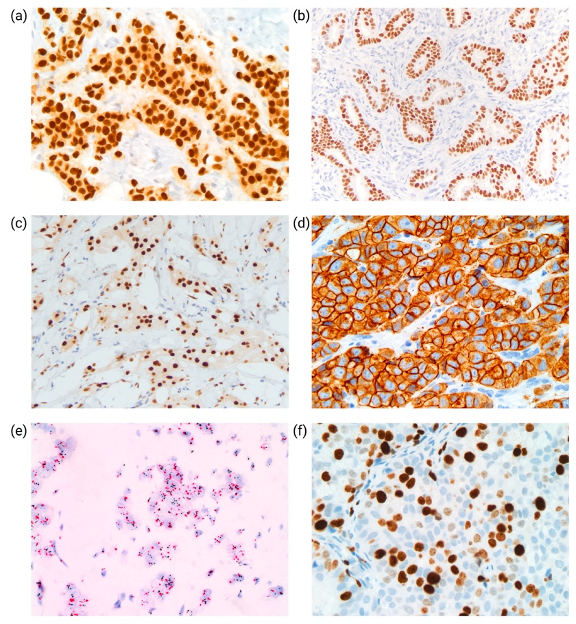 Fig. 1. Biomarker analysis for subtyping of breast cancer
