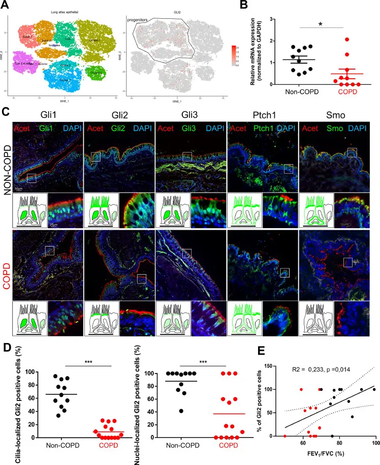 Alteration of Gli2 localization in AEC is associated with COPD