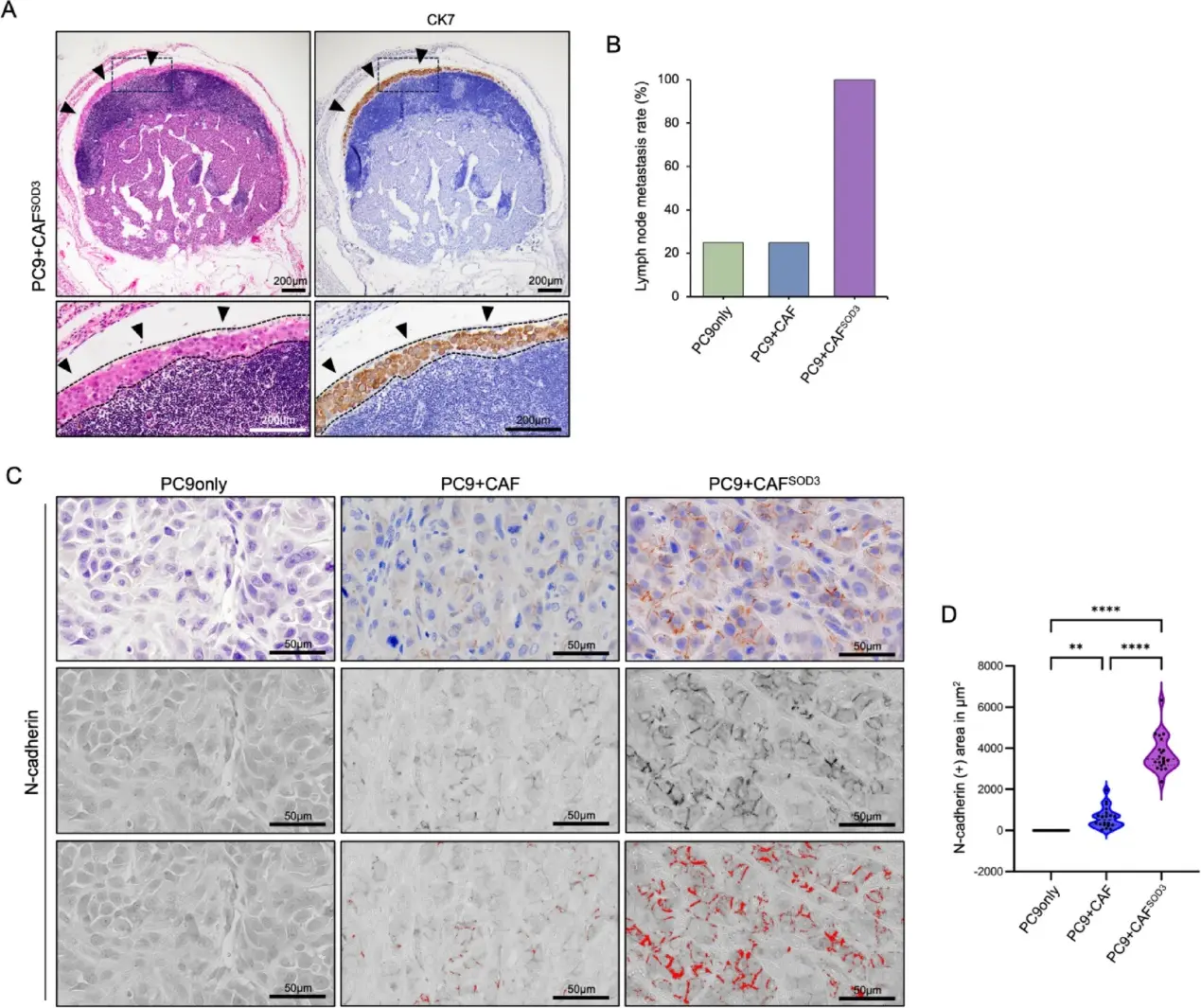SOD3 overexpression in CAF promotes tumor metastasis to lymph nodes and the epithelial-mesenchymal transition process in LUAD.