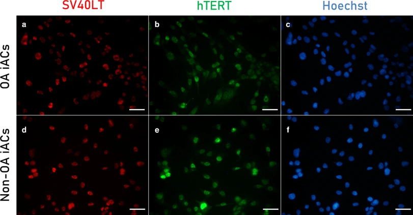 SV40 large T antigen (SV40LT) and eGFP-telomerase reverse transcriptase (hTERT) immunostaining and Hoechst staining of a), b), and c) osteoarthritic (OA) and d), e), and f) non-OA immortalized articular chondrocytes (iACs).