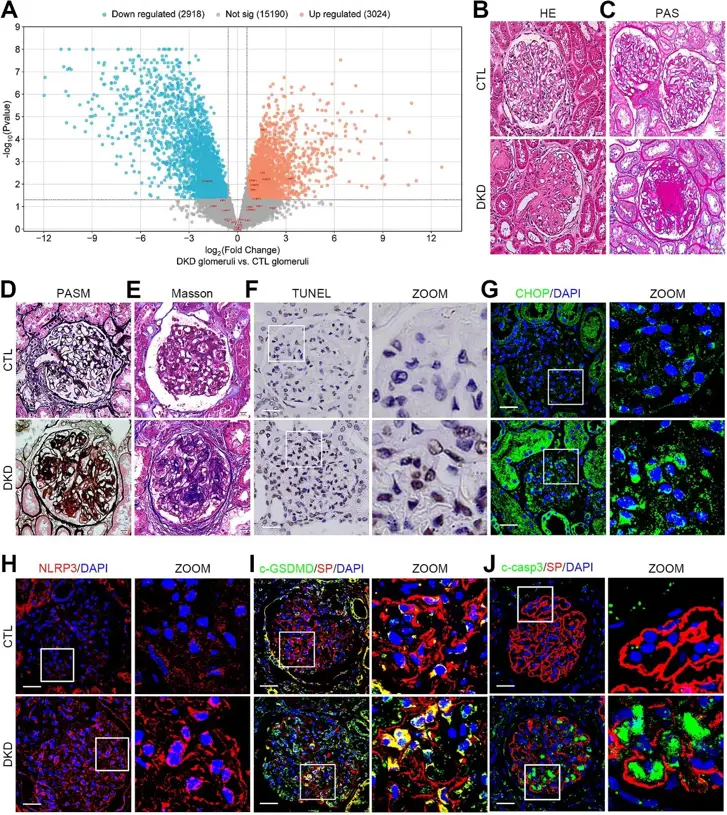 UPR, NLRP3 inflammasome-mediated pyroptosis, and apoptosis were promoted in podocytes from DKD patients.