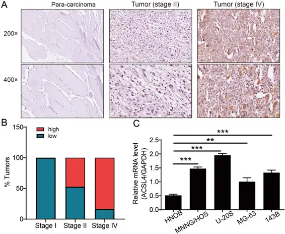 Expression of ACSL4 was elevated in OS.