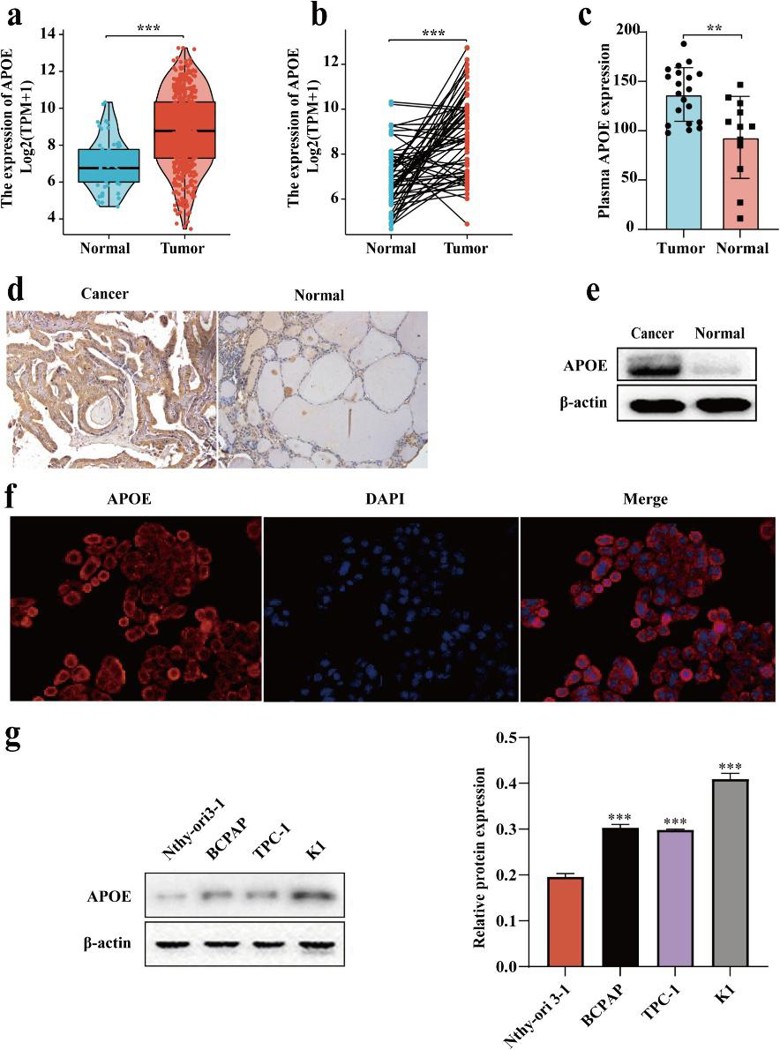 APOE is highly expressed in PTC tumor organizations.