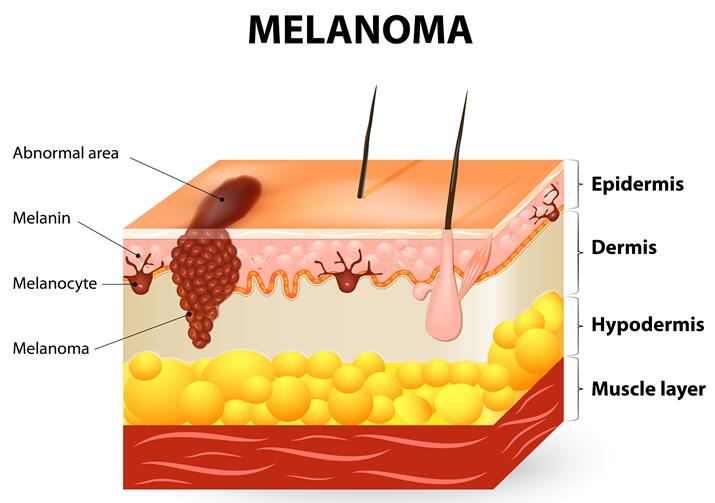 Melanoma Cells