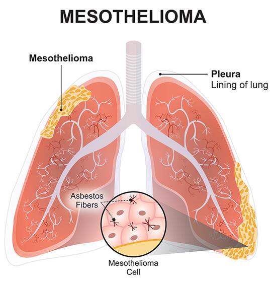 Mesothelioma Cells