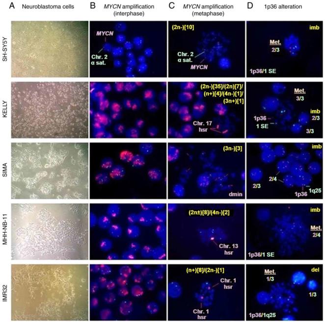 MYCN amplification and 1p36 alterations from interphase and metaphase in neuroblastoma cell lines.