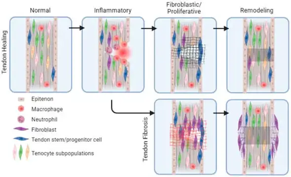 Schematic of stages of tendon healing and fibrosis and the cells involved.