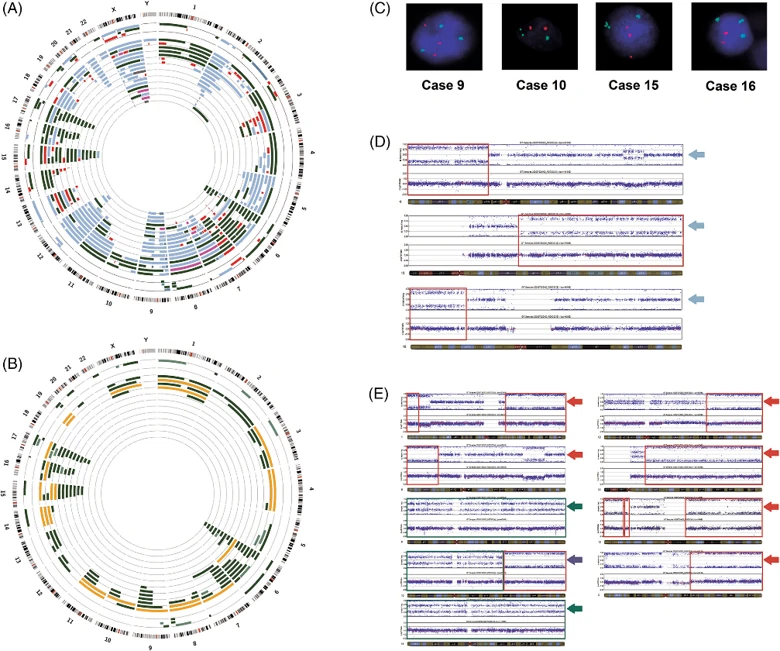 Genomic aberrations in PMBL. Circos plots for data visualization.