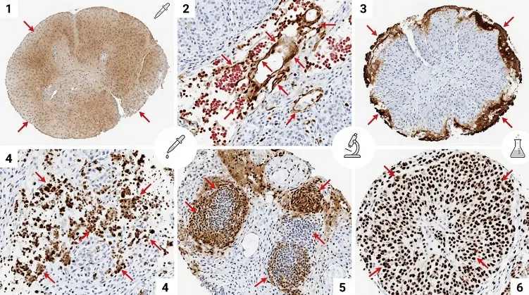 Common high-background staining patterns in immunohistochemistry. Diffuse haze, blood-associated staining, edge effects, granular precipitates, immune-cell-associated background, and unexpected nuclear staining may arise from different technical causes and should be investigated using pattern-specific troubleshooting steps.